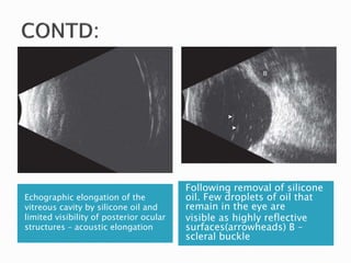 Echographic elongation of the
vitreous cavity by silicone oil and
limited visibility of posterior ocular
structures – acoustic elongation
Following removal of silicone
oil. Few droplets of oil that
remain in the eye are
visible as highly reflective
surfaces(arrowheads) B –
scleral buckle
 