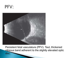 Persistent fetal vasculature (PFV). Taut, thickened
vitreous band adherent to the slightly elevated optic
disc.
 