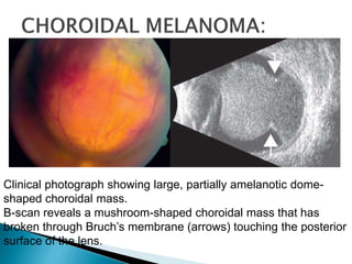 Clinical photograph showing large, partially amelanotic dome-
shaped choroidal mass.
B-scan reveals a mushroom-shaped choroidal mass that has
broken through Bruch’s membrane (arrows) touching the posterior
surface of the lens.
 