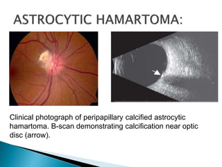 Clinical photograph of peripapillary calcified astrocytic
hamartoma. B-scan demonstrating calcification near optic
disc (arrow).
 
