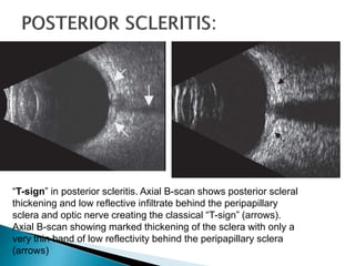 “T-sign” in posterior scleritis. Axial B-scan shows posterior scleral
thickening and low reflective infiltrate behind the peripapillary
sclera and optic nerve creating the classical “T-sign” (arrows).
Axial B-scan showing marked thickening of the sclera with only a
very thin band of low reflectivity behind the peripapillary sclera
(arrows)
 