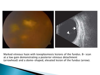 Marked vitreous haze with toxoplasmosis lesions of the fundus. B- scan
at a low gain demonstrating a posterior vitreous detachment
(arrowhead) and a dome-shaped, elevated lesion of the fundus (arrow).
 