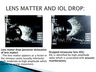 Dropped intraocular lens (IOL)
IOL is identified by high amplitude
spike which is associated with acoustic
reverberations.
Lens matter drop (posterior dislocation
of lens matter)
. The lens matter appears as a lesion in
the vitreous cavity (usually inferiorly)
with moderate to high amplitude which
moves on ocular movement.
 
