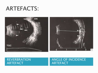 REVERBRATION
ARTEFACT
ANGLE OF INCIDENCE
ARTEFACT
 