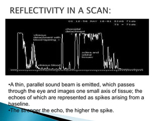 •A thin, parallel sound beam is emitted, which passes
through the eye and images one small axis of tissue; the
echoes of which are represented as spikes arising from a
baseline.
•The stronger the echo, the higher the spike.
 