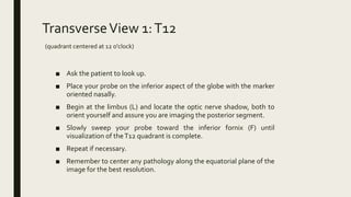 TransverseView 1:T12
(quadrant centered at 12 o'clock)
■ Ask the patient to look up.
■ Place your probe on the inferior aspect of the globe with the marker
oriented nasally.
■ Begin at the limbus (L) and locate the optic nerve shadow, both to
orient yourself and assure you are imaging the posterior segment.
■ Slowly sweep your probe toward the inferior fornix (F) until
visualization of theT12 quadrant is complete.
■ Repeat if necessary.
■ Remember to center any pathology along the equatorial plane of the
image for the best resolution.
 