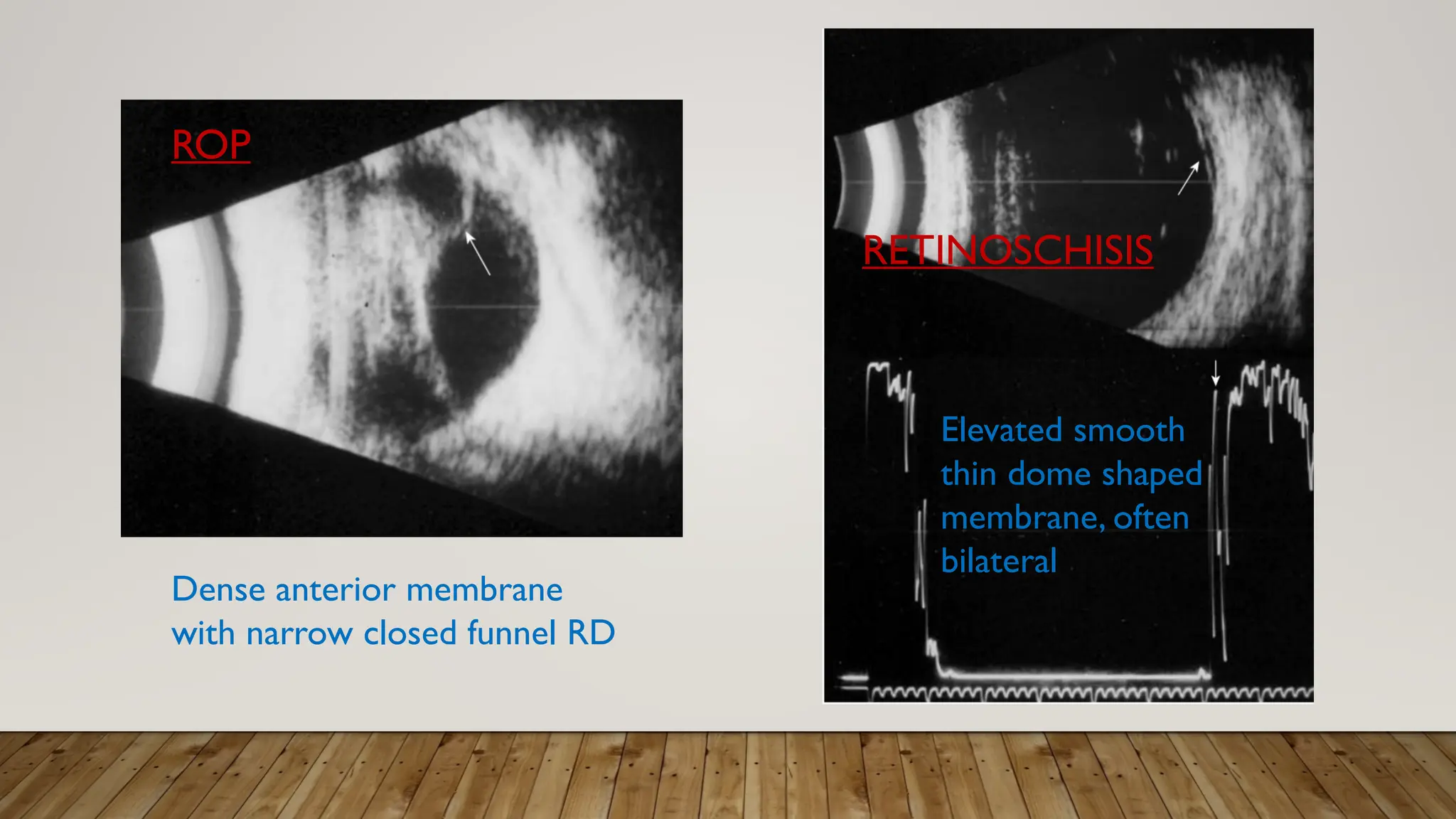 Dense anterior membrane
with narrow closed funnel RD
Elevated smooth
thin dome shaped
membrane, often
bilateral
RETINOSCHISIS
ROP
 