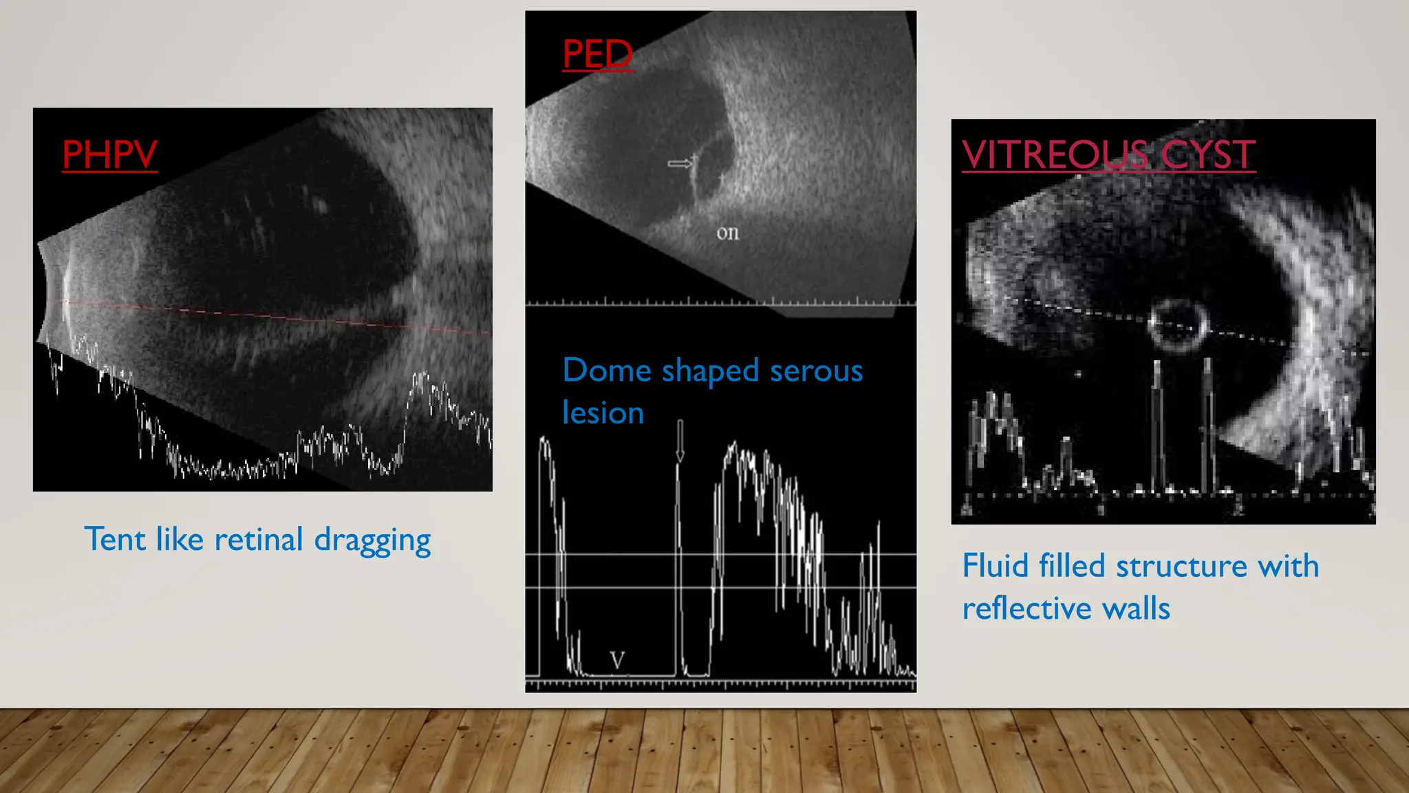 VITREOUS CYST
Dome shaped serous
lesion
PED
PHPV
Tent like retinal dragging
Fluid filled structure with
reflective walls
 