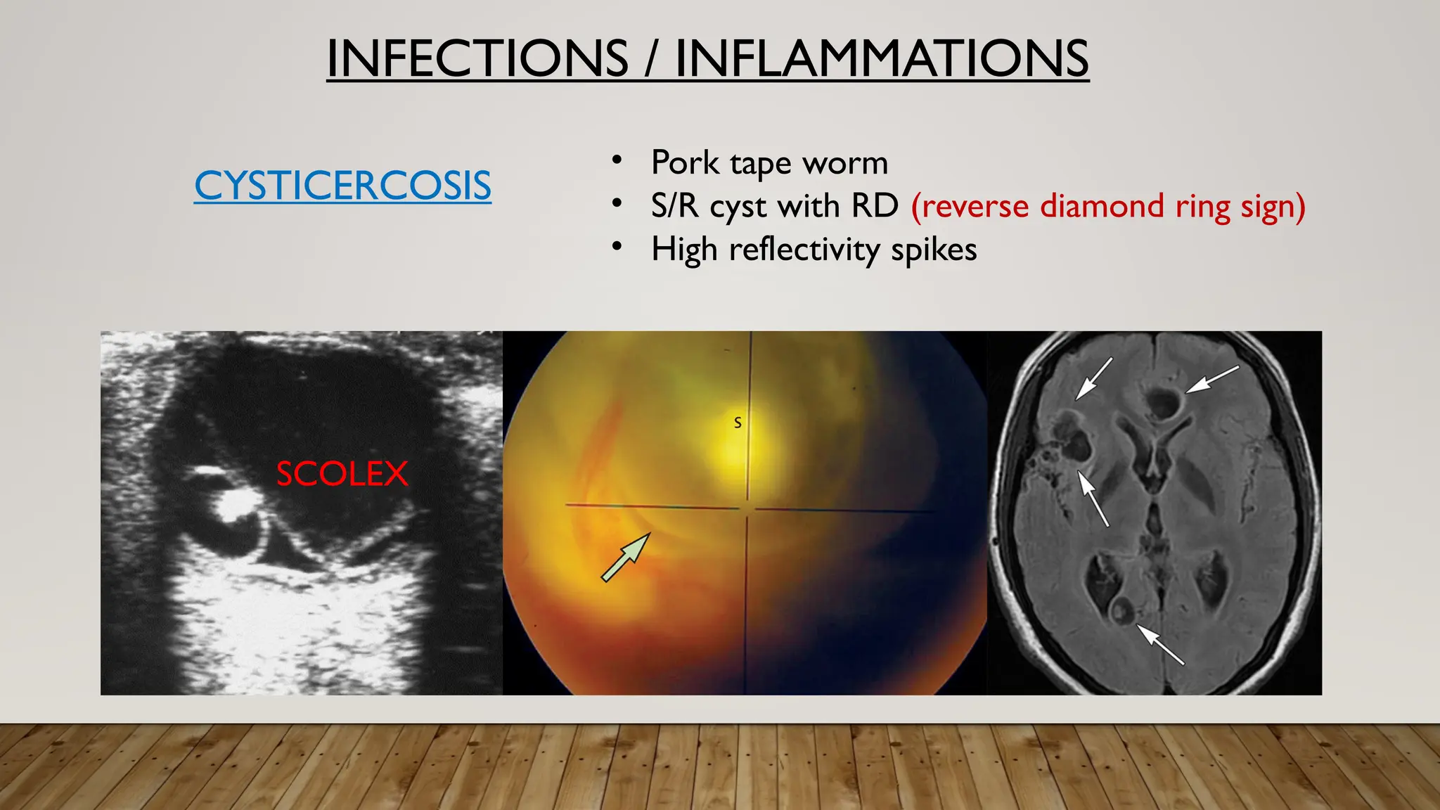 INFECTIONS / INFLAMMATIONS
CYSTICERCOSIS
• Pork tape worm
• S/R cyst with RD (reverse diamond ring sign)
• High reflectivity spikes
SCOLEX
 