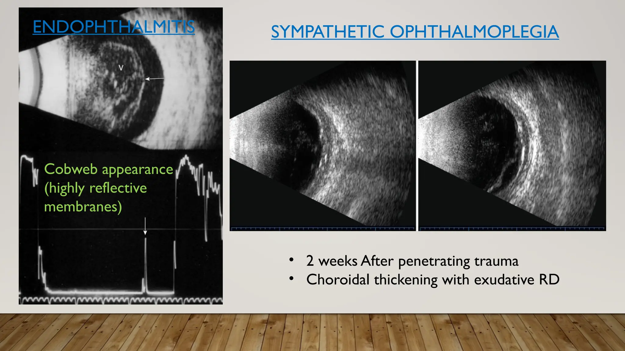 ENDOPHTHALMITIS
Cobweb appearance
(highly reflective
membranes)
SYMPATHETIC OPHTHALMOPLEGIA
• 2 weeks After penetrating trauma
• Choroidal thickening with exudative RD
 