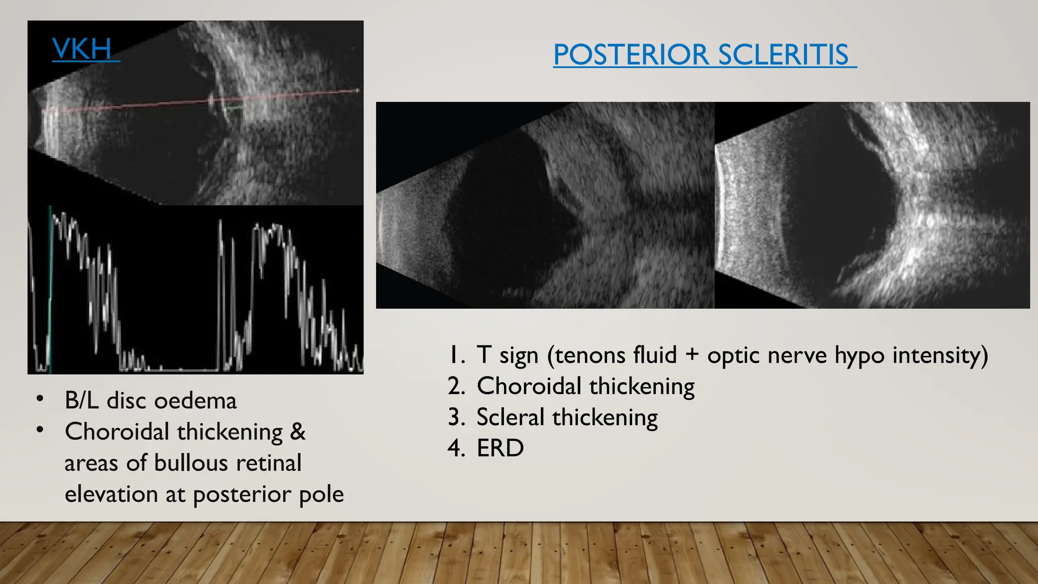 • B/L disc oedema
• Choroidal thickening &
areas of bullous retinal
elevation at posterior pole
VKH
1. T sign (tenons fluid + optic nerve hypo intensity)
2. Choroidal thickening
3. Scleral thickening
4. ERD
POSTERIOR SCLERITIS
 