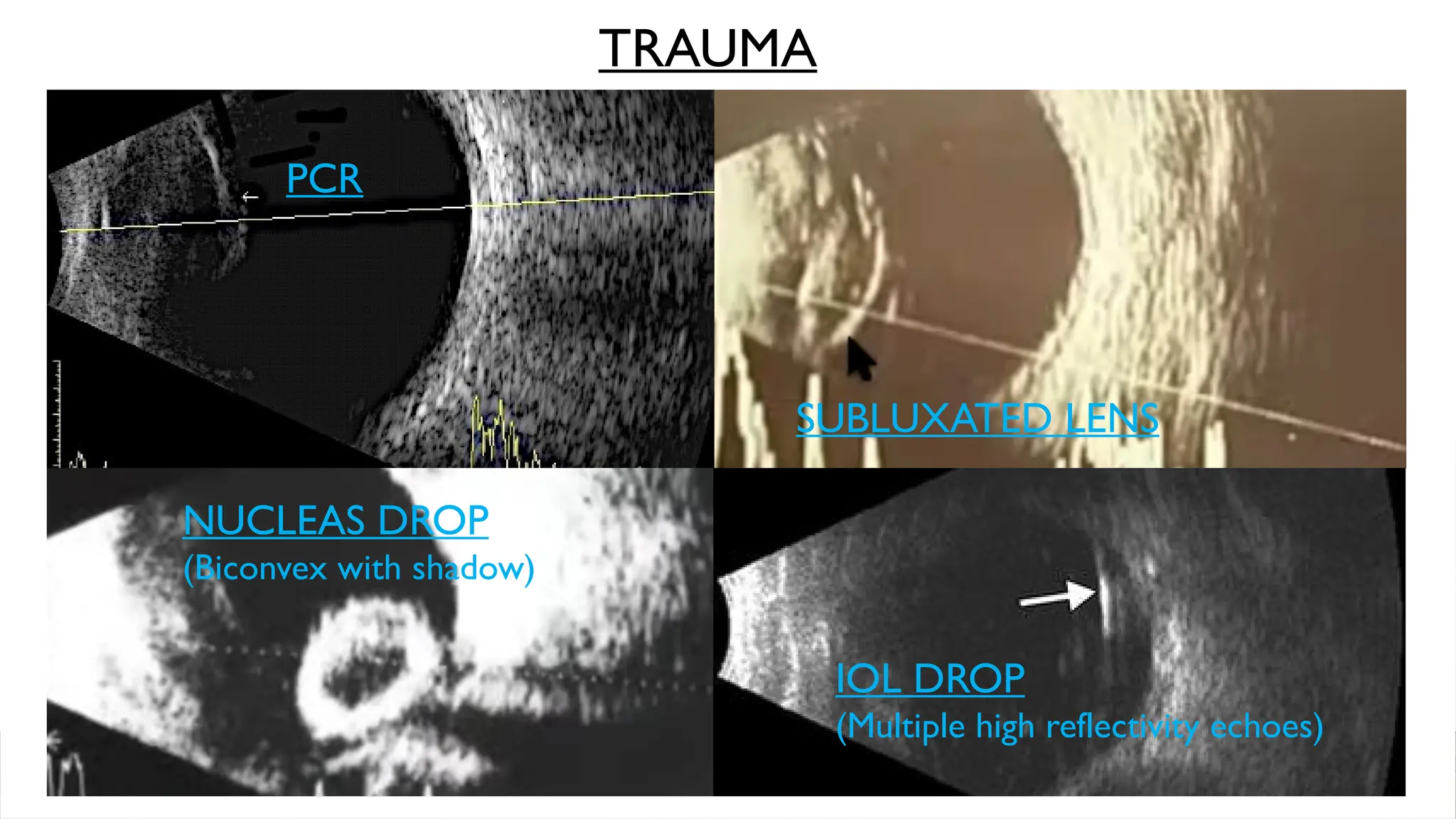 SUBLUXATED LENS
PCR
IOL DROP
(Multiple high reflectivity echoes)
TRAUMA
NUCLEAS DROP
(Biconvex with shadow)
 