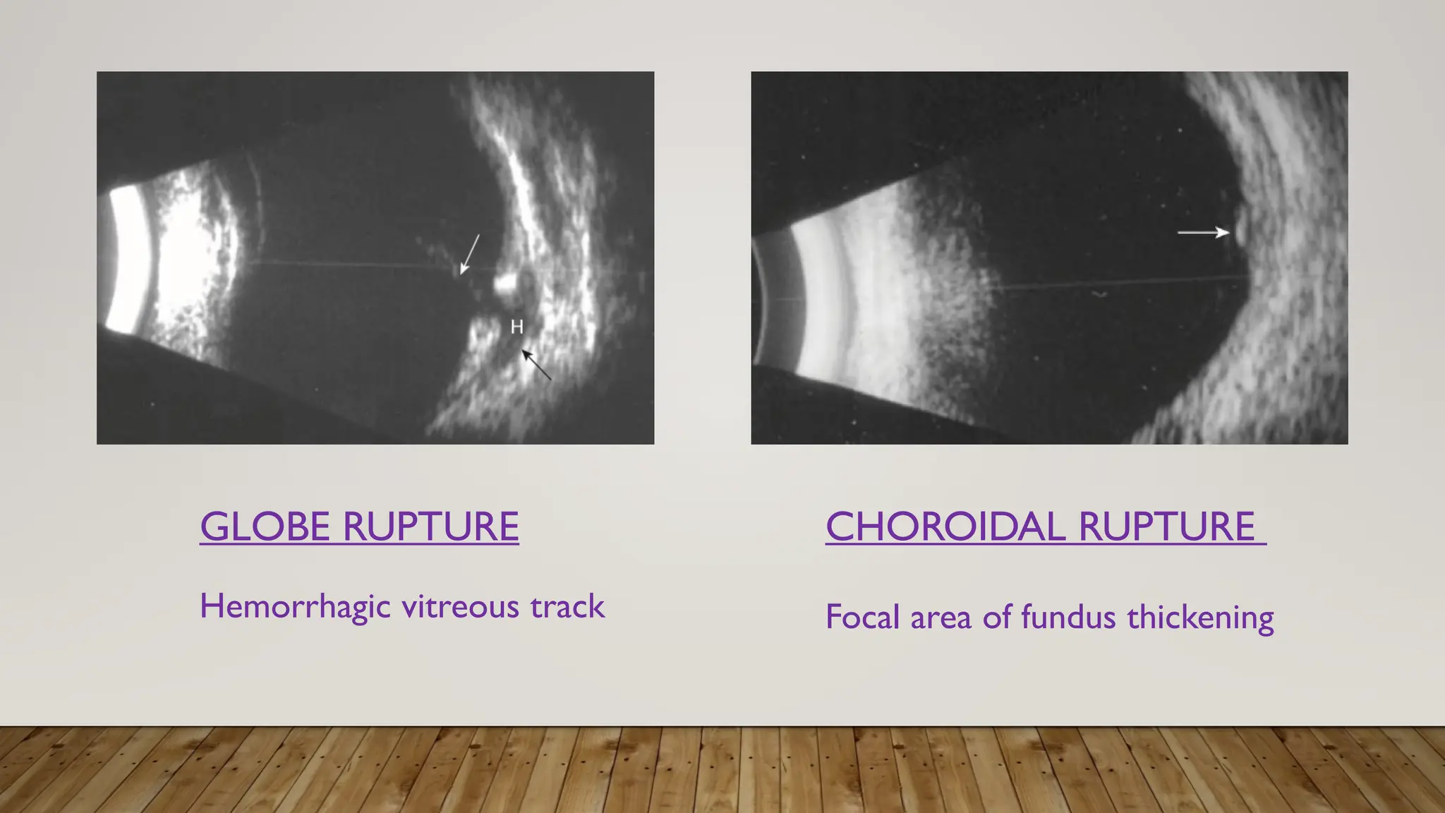 GLOBE RUPTURE
Hemorrhagic vitreous track
CHOROIDAL RUPTURE
Focal area of fundus thickening
 
