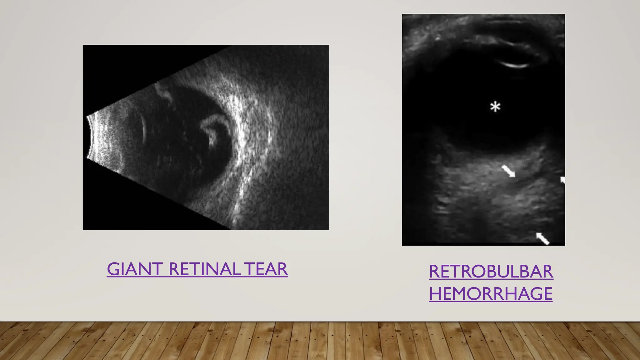 RETROBULBAR
HEMORRHAGE
GIANT RETINALTEAR
 