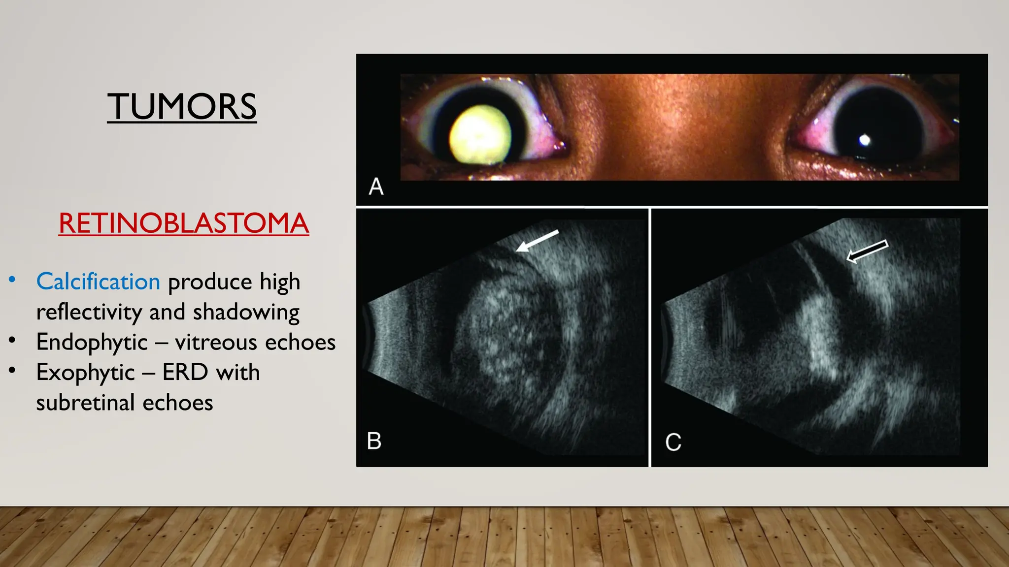 TUMORS
• Calcification produce high
reflectivity and shadowing
• Endophytic – vitreous echoes
• Exophytic – ERD with
subretinal echoes
RETINOBLASTOMA
 