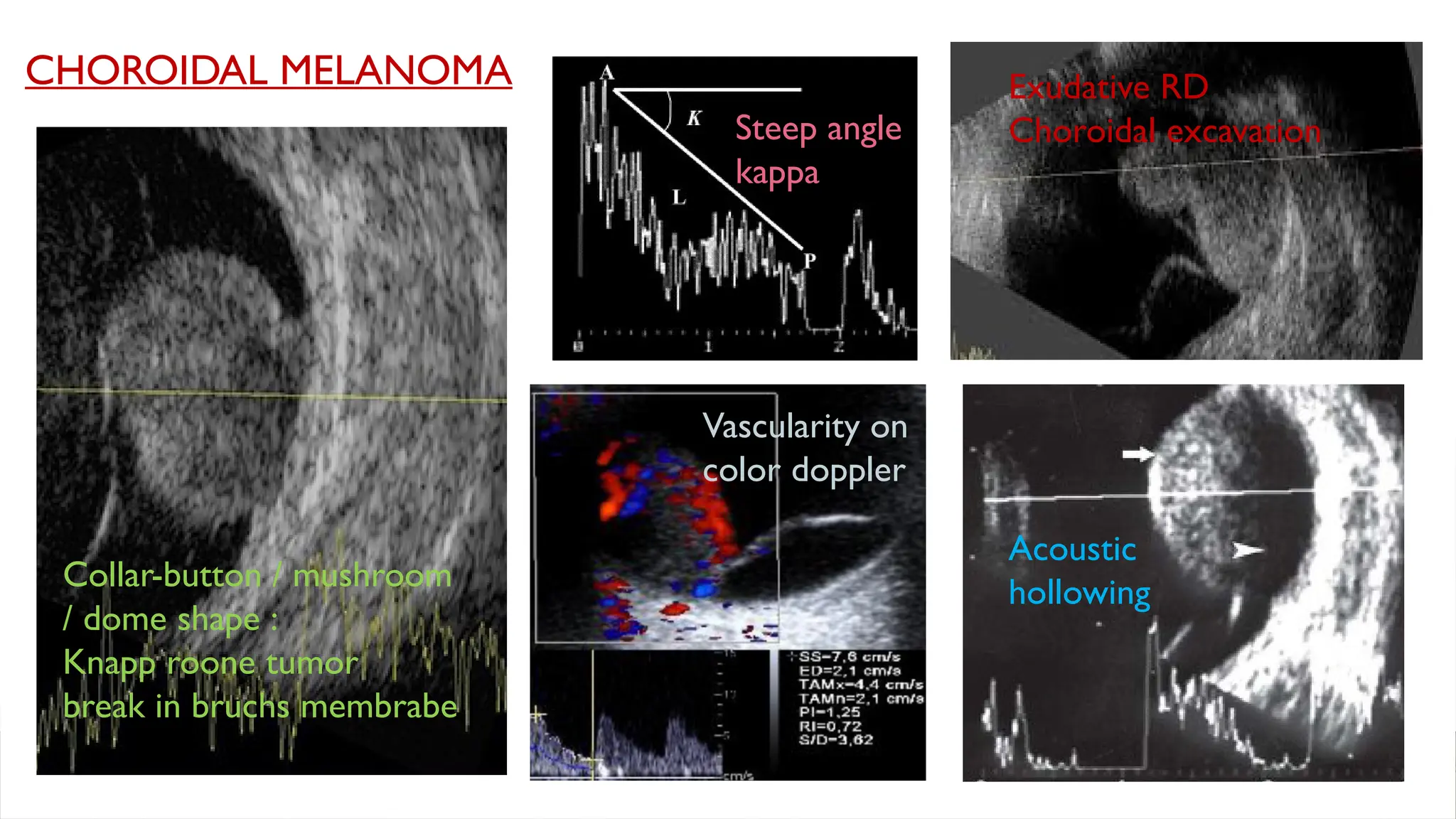 CHOROIDAL MELANOMA
Collar-button / mushroom
/ dome shape :
Knapp roone tumor
break in bruchs membrabe
Exudative RD
Choroidal excavation
Steep angle
kappa
Acoustic
hollowing
Vascularity on
color doppler
 