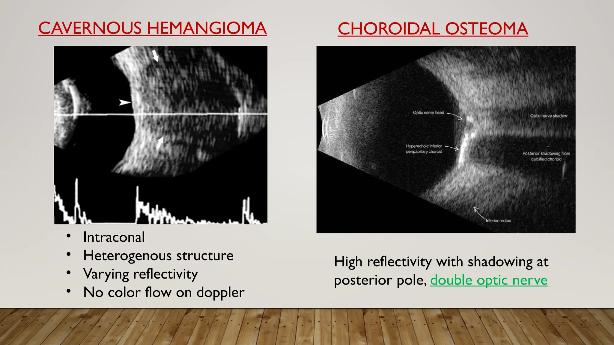 CAVERNOUS HEMANGIOMA
High reflectivity with shadowing at
posterior pole, double optic nerve
CHOROIDAL OSTEOMA
• Intraconal
• Heterogenous structure
• Varying reflectivity
• No color flow on doppler
 
