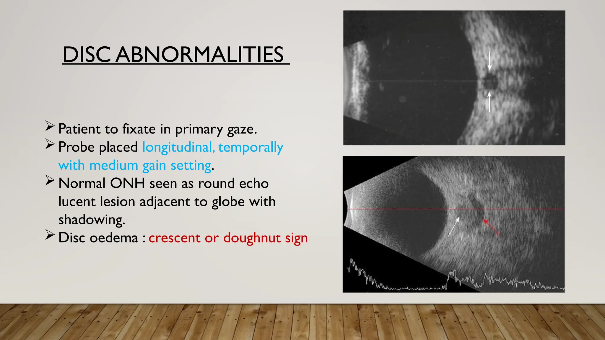 DISC ABNORMALITIES
Patient to fixate in primary gaze.
Probe placed longitudinal, temporally
with medium gain setting.
Normal ONH seen as round echo
lucent lesion adjacent to globe with
shadowing.
Disc oedema : crescent or doughnut sign
 