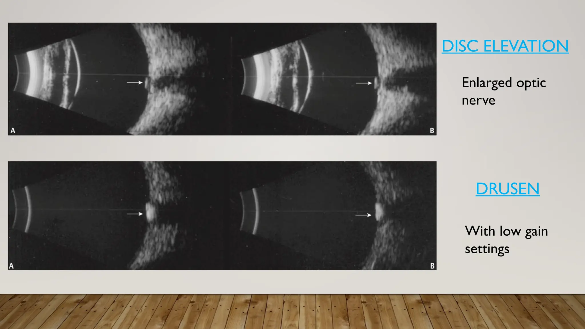 DISC ELEVATION
DRUSEN
Enlarged optic
nerve
With low gain
settings
 