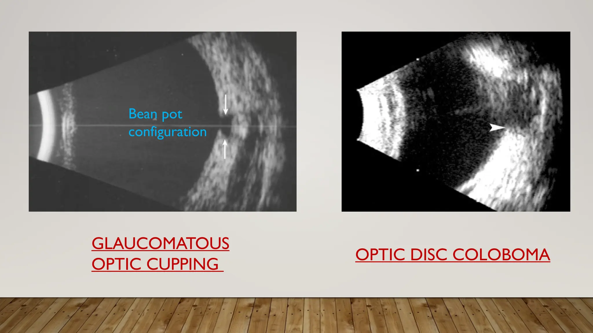 GLAUCOMATOUS
OPTIC CUPPING
OPTIC DISC COLOBOMA
Bean pot
configuration
 