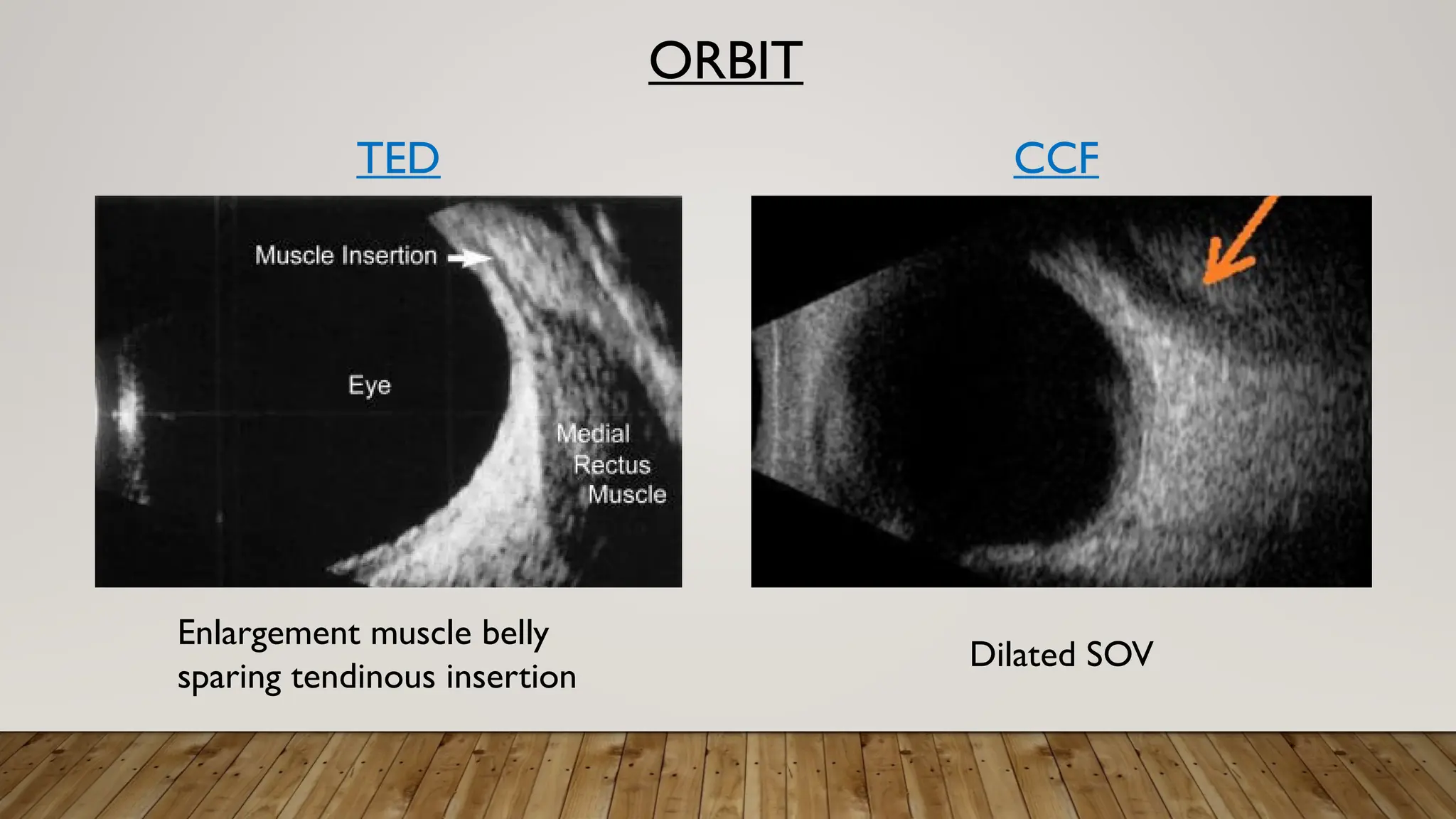 ORBIT
Enlargement muscle belly
sparing tendinous insertion
TED
Dilated SOV
CCF
 