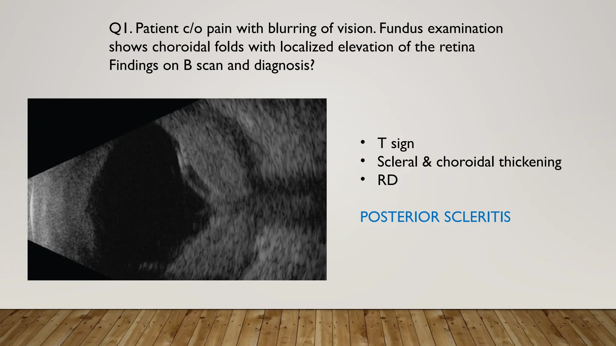 Q1. Patient c/o pain with blurring of vision. Fundus examination
shows choroidal folds with localized elevation of the retina
Findings on B scan and diagnosis?
• T sign
• Scleral & choroidal thickening
• RD
POSTERIOR SCLERITIS
 