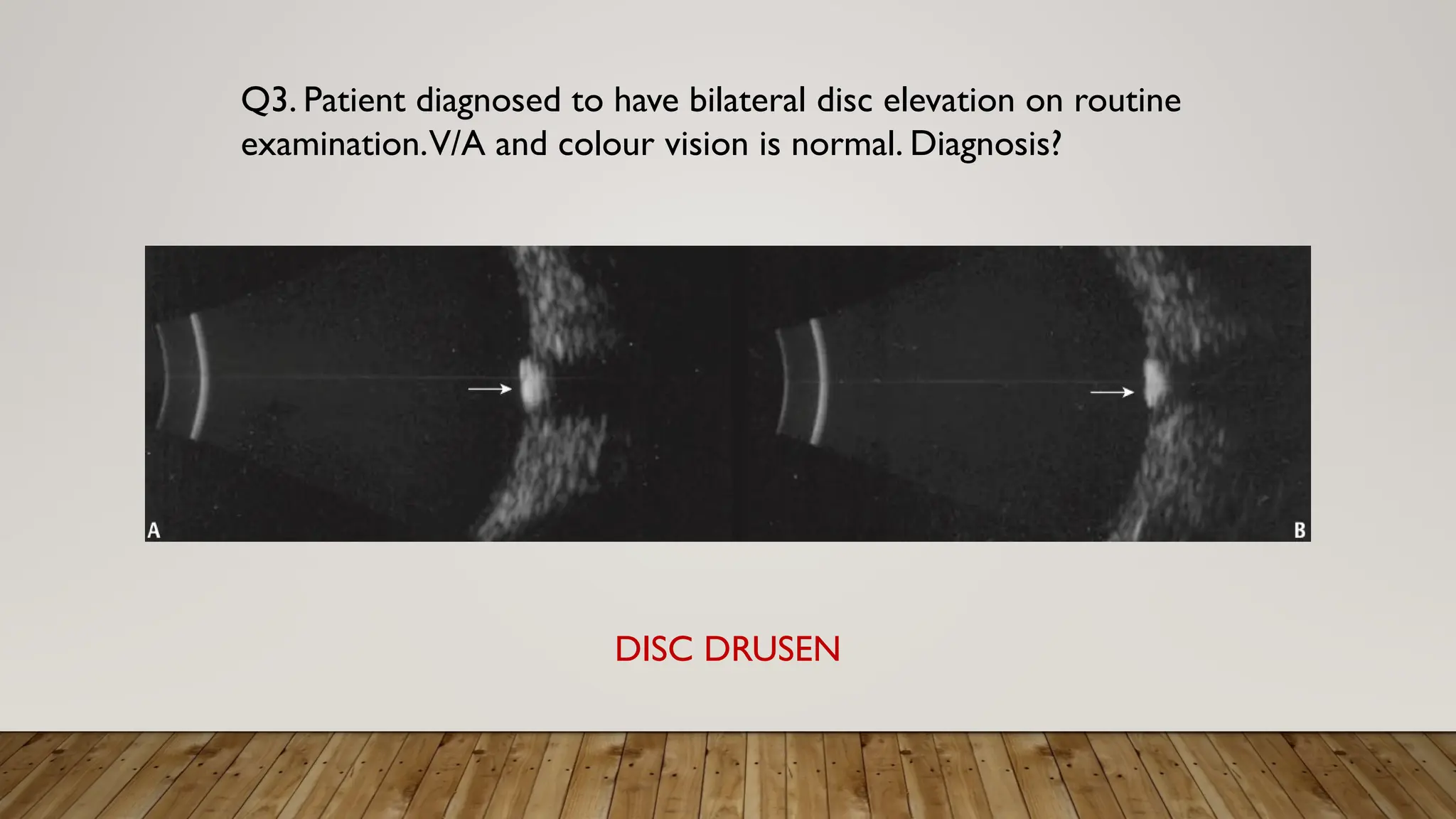 Q3. Patient diagnosed to have bilateral disc elevation on routine
examination.V/A and colour vision is normal. Diagnosis?
DISC DRUSEN
 