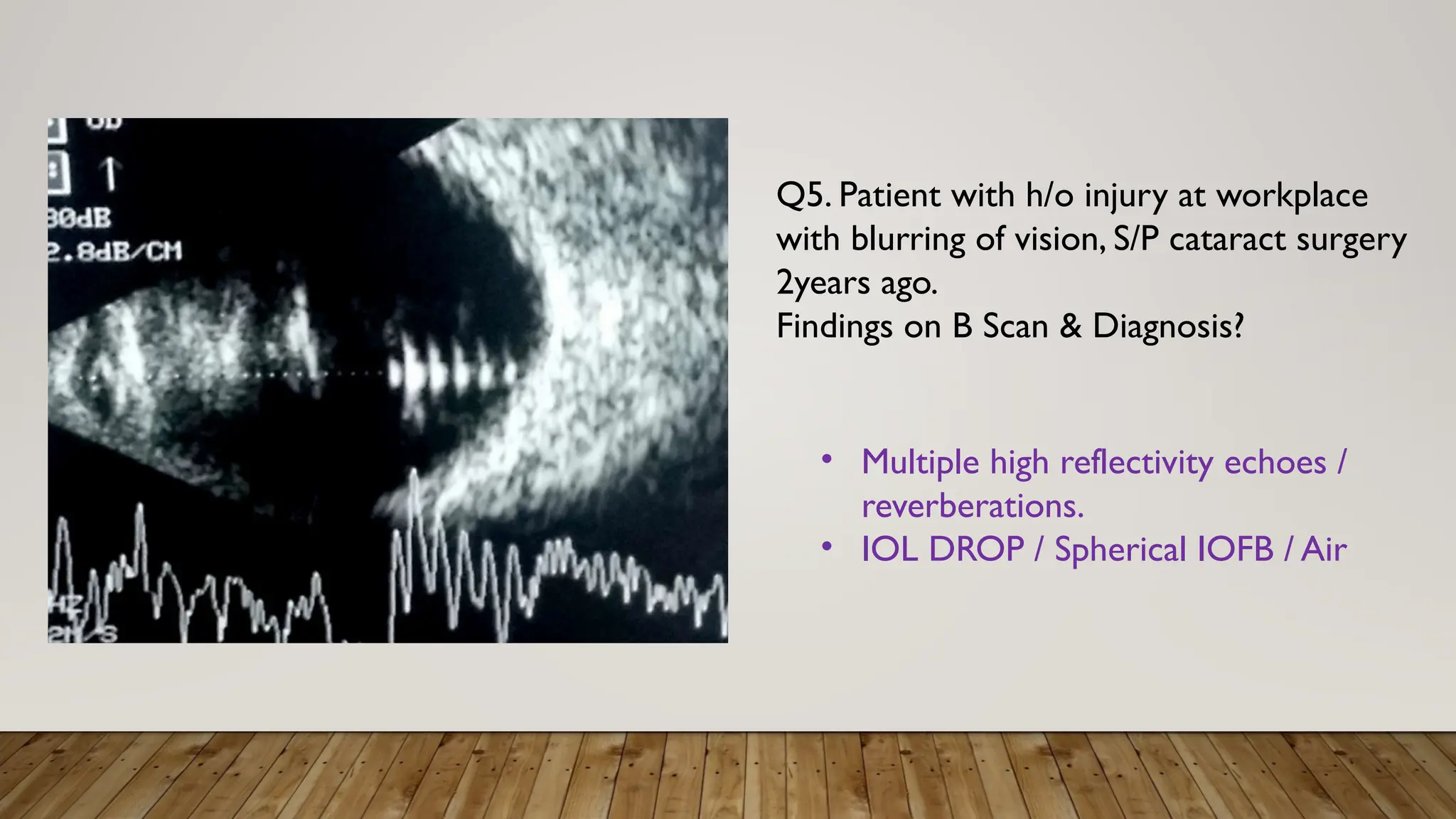 Q5. Patient with h/o injury at workplace
with blurring of vision, S/P cataract surgery
2years ago.
Findings on B Scan & Diagnosis?
• Multiple high reflectivity echoes /
reverberations.
• IOL DROP / Spherical IOFB / Air
 