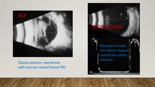 B-Scan procedure basics in ophthalmology.pptx
