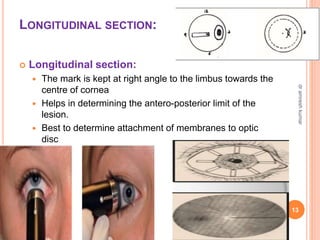 LONGITUDINAL SECTION:
 Longitudinal section:
 The mark is kept at right angle to the limbus towards the
centre of cornea
 Helps in determining the antero-posterior limit of the
lesion.
 Best to determine attachment of membranes to optic
disc
13
dr
amresh
kumar
 