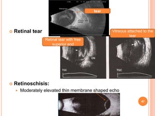 Retinal tear
 Retinoschisis:
 Moderately elevated thin membrane shaped echo
Retinal tear with free
superior end
Vitreous attached to the
tear
tear
47
dr
amresh
kumar
 