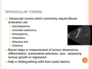 INTRAOCULAR TUMORS
 Intraocular tumors which commonly require Bscan
evaluation are
 retinoblastoma,
 choroidal melanoma,
 hemangioma,
 metastasis,
 diktyoma and
 Osteoma
 Bscan helps in measurement of tumour dimensions,
differentiation ,extrascleral extension, size , assessing
tumour growth or regression
 help in distinguishing solid from cystic lesions
48
dr
amresh
kumar
 