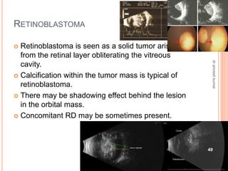 RETINOBLASTOMA
 Retinoblastoma is seen as a solid tumor arising
from the retinal layer obliterating the vitreous
cavity.
 Calcification within the tumor mass is typical of
retinoblastoma.
 There may be shadowing effect behind the lesion
in the orbital mass.
 Concomitant RD may be sometimes present.
49
dr
amresh
kumar
 