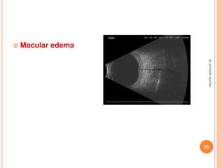  Macular edema
63
dr
amresh
kumar
 