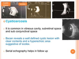 Cysticercosis
 It is common in vitreous cavity, subretinal space
and sub conjunctival space
 Bscan reveals a well defined cystic lesion with
clear contents and a hyperechoic area
suggestive of scolex.
 Serial echography helps in follow up
scolex
Cystic
lesion
67
dr
amresh
kumar
 