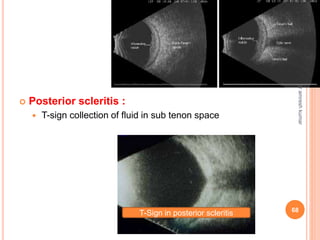  Posterior scleritis :
 T-sign collection of fluid in sub tenon space
T-Sign in posterior scleritis 68
dr
amresh
kumar
 
