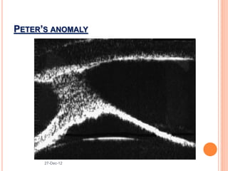 PETER’S ANOMALY
27-Dec-12
 