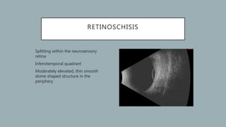 Retinal Splitting B scan ultrasonography | PPTX