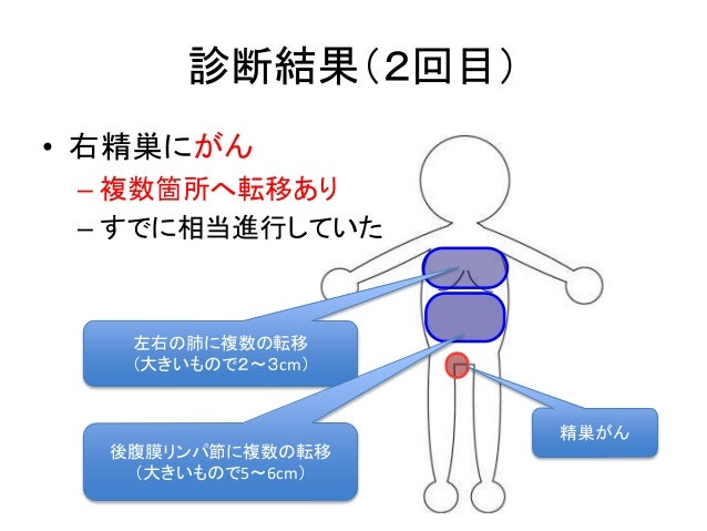 30代前半で精巣がんになった話
