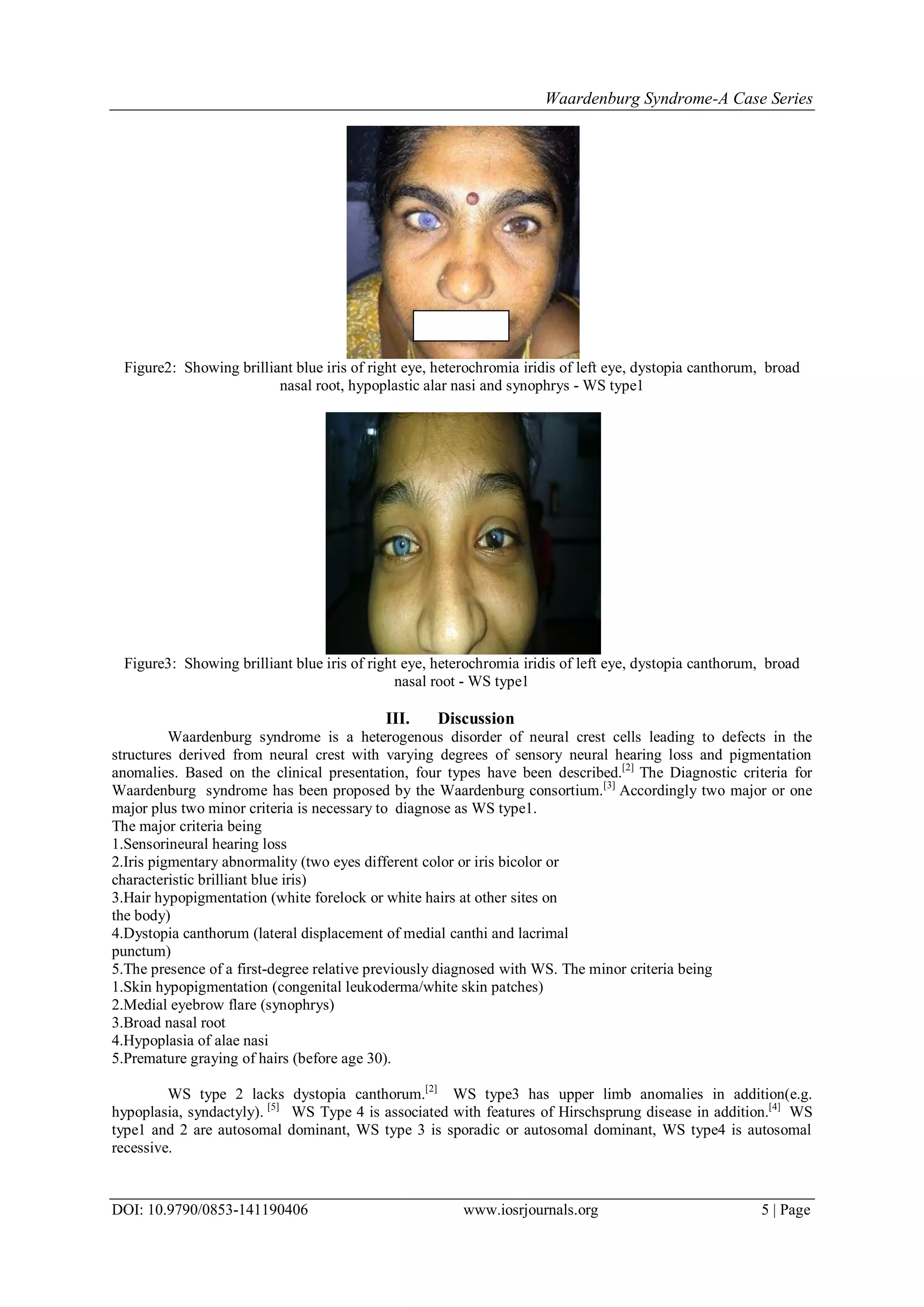 Waardenburg Syndrome-A Case Series | PDF