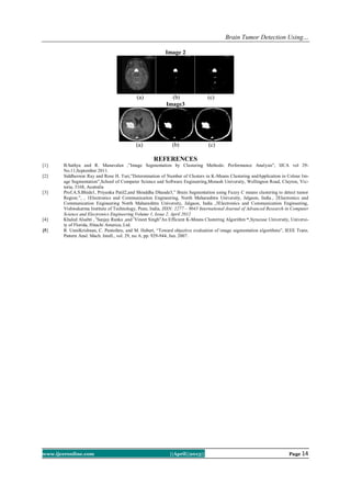 Brain Tumor Detection Using…
www.ijceronline.com ||April||2013|| Page 14
Image 2
(a) (b) (c)
Image3
(a) (b) (c)
REFERENCES
[1] B.Sathya and R. Manavalan ,”Image Segmentation by Clustering Methods: Performance Analysis”, IJCA vol 29-
No.11,September 2011.
[2] Siddheswar Ray and Rose H. Turi,”Determination of Number of Clusters in K-Means Clustering andApplication in Colour Im-
age Segmentation”,School of Computer Science and Software Engineering,Monash University, Wellington Road, Clayton, Vic-
toria, 3168, Australia
[3] Prof.A.S.Bhide1, Priyanka Patil2,and Shraddha Dhande3,” Brain Segmentation using Fuzzy C means clustering to detect tumor
Region.”, , 1Electronics and Communication Engineering, North Maharashtra University, Jalgaon, India., 2Electronics and
Communication Engineering North Maharashtra University, Jalgaon, India ,3Electronics and Communication Engineering,
Vishwakarma Institute of Technology, Pune, India, ISSN: 2277 – 9043 International Journal of Advanced Research in Computer
Science and Electronics Engineering Volume 1, Issue 2, April 2012
[4] Khaled Alsabti , 2
Sanjay Ranka ,and 3
Vineet Singh”An Efficient K-Means Clustering Algorithm “,Syracuse University, Universi-
ty of Florida, Hitachi America, Ltd.
[5] R. UnniKrishnan, C. Pantofaru, and M. Hebert, “Toward objective evaluation of image segmentation algorithms”, IEEE Trans.
Pattern Anal. Mach. Intell., vol. 29, no. 6, pp. 929-944, Jun. 2007.
 