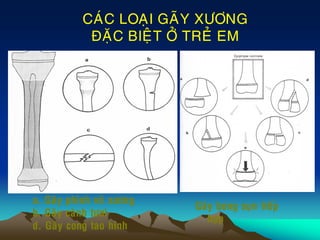 a. Gaõy phình voõ xöông
b. Gaõy caønh töôi
d. Gaõy cong tao hình
CAÙC LOAÏI GAÕY XÖÔNG
ÑAËC BIEÄT ÔÛ TREÛ EM
Gaõy bong suïn tieáp
hôïp
 