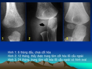 Hình 1: 6 thaùng ñaàu, chöa coát hoùa
Hình 2: 12 thaùng, thaáy ñöôïc trung taâm coát hoùa loài caàu ngoaøi
Hình 3: 24 thaùng, trung taâm coát hoùa loài caàu ngoaøi coù hình oval
1 2 3
 