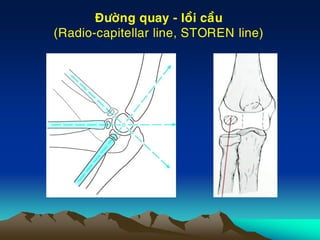 Ñöôøng quay - loài caàu
(Radio-capitellar line, STOREN line)
 