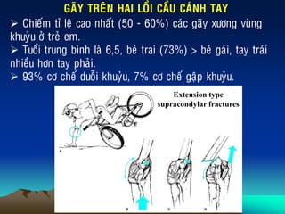 GAÕY TREÂN HAI LOÀI CAÀU CAÙNH TAY
 Chieám tæ leä cao nhaát (50 - 60%) caùc gaõy xöông vuøng
khuyûu ôû treû em.
 Tuoåi trung bình laø 6,5, beù trai (73%) > beù gaùi, tay traùi
nhieàu hôn tay phaûi.
 93% cô cheá duoãi khuyûu, 7% cô cheá gaäp khuyûu.
Extension type
supracondylar fractures
 