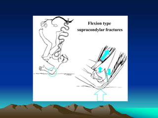 Flexion type
supracondylar fractures
 