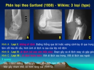 Phaân loaïi theo Gartland (1959) - Wilkins: 3 loaïi (type)
Hình A : Loaïi I: khoâng di leäch. Ñöôøng thaúng qua bôø tröôùc xöông caùnh tay ñi qua trung
taâm coát hoùa loài caàu, hình aûnh di leäch ra sau cuûa lôùp môû ñeäm
Hình B : Loaïi II: di leäch (voû sau coøn tieáp xuùc). Ñoaïn gaõy xa di leäch xoay vaø gaäp goùc
Hình C : Loaïi III : di leäch hoaøn toaøn. IIIA di leäch sau trong. IIIB di leäch sau ngoaøi
X quang:
- Gaõy ôû haønh xöông, ñöôøng gaõy naèm phía treân suïn tieáp hôïp
- Maët gaõy nham nhôû, coù hình raêng cöa (hình C)
A B C
 