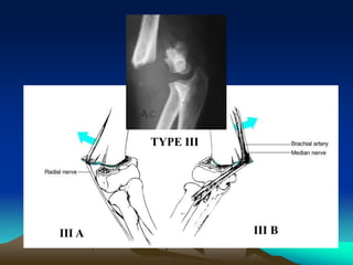 TYPE III
III A III B
 