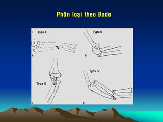 Phaân loaïi theo Bado
 