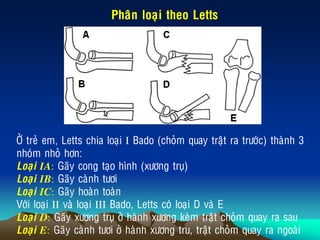 Phaân loaïi theo Letts
ÔÛ treû em, Letts chia loaïi I Bado (choûm quay traät ra tröôùc) thaønh 3
nhoùm nhoû hôn:
Loaïi IA: Gaõy cong taïo hình (xöông truï)
Loaïi IB: Gaõy caønh töôi
Loaïi IC: Gaõy hoaøn toaøn
Vôùi loaïi II vaø loaïi III Bado, Letts coù loaïi D vaø E
Loaïi D: Gaõy xöông truï ôû haønh xöông keøm traät choûm quay ra sau
Loaïi E: Gaõy caønh töôi ôû haønh xöông tru, traät choûm quay ra ngoaøi
 